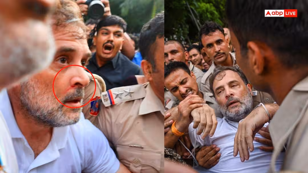 नाक से बहा खून, छाती में चोट…, प्रदर्शन के दौरान राहुल गांधी के घायल होने की आई तस्वीर